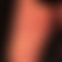 Differenzialdiagnose:&nbsp;Tinea inguinalis

Diagnose: Erythema chronicum migrans; reaktionlose R...