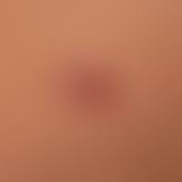 Lymphadenosis cutis benigna: seit mehreren Monaten bestehend. Offenbar langsames Wachstum. Keine ...