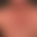 Argyrose: flächige Hyperpiementierug; bei seitlicher Sichtweise, metallischer Glanz der Haut.

&n...