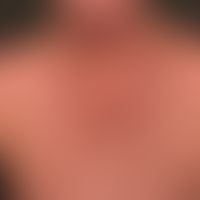 Argyrose: flächige Hyperpiementierug; bei seitlicher Sichtweise, metallischer Glanz der Haut.

&n...