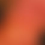 Argyrie: diffuse, graubräunliche&nbsp;Verfärbung der Gesichtshaut un der seitl. Halspartein.

&nb...