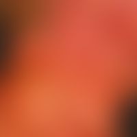 Argyrie: diffuse, graubräunliche&nbsp;Verfärbung der Gesichtshaut un der seitl. Halspartein.

&nb...
