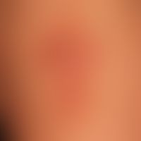 Necrobiosis lipoidica: Verlaufskontrolle, Ausgangsbefund
