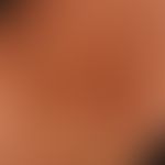 Diiferenzialdiagnose:&nbsp;Acanthosis nigricans

Diagnose: Zirkumskripte Sklerodermie. Braune wen...