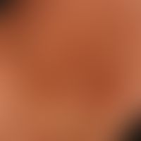 Diiferenzialdiagnose:&nbsp;Acanthosis nigricans

Diagnose: Zirkumskripte Sklerodermie. Braune wen...