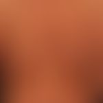 Zirkumskripte Sklerodermie (Plaquestyp):&nbsp;Die deutlich pigmentierten großflächigen wenig infi...