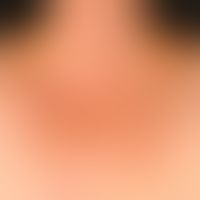 Differenzialdiagnose:REM-Syndrom

Diagnose: Lupus erythematodes tumidus
