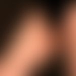 Fibroma molle: multiple weiche Fibrome auf chagrinierter Haut. Zugrundeliegende Bourenville-Pring...