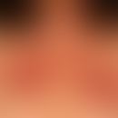 Allergie: klassische Kontaktallergie (Typ IV-Reaktion) mit unscharf begrenzter Kontaktdermatitis....