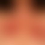 Allergie: klassische Kontaktallergie (Typ IV-Reaktion) mit unscharf begrenzter Kontaktdermatitis....