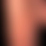 Kollagenose, reaktive perforierende: vor etwa 8&nbsp;Monaten erstmals aufgetretene, unterschiedli...