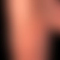 Kollagenose, reaktive perforierende: vor etwa 8&nbsp;Monaten erstmals aufgetretene, unterschiedli...