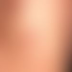Kollagenose, reaktive perforierende: &nbsp;vor etwa 8&nbsp;Monaten erstmals aufgetretene, untersc...