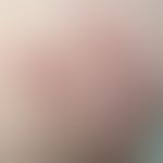 Elastosis perforans serpiginosa: großflächige, stellenweise angedeudet an anuläre rote Plaques un...