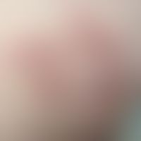 Elastosis perforans serpiginosa: großflächige, stellenweise angedeudet an anuläre rote Plaques un...