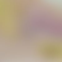 Elastosis perforans serpiginosa: perforierte Follkelwand mit perifollikulärer Inflammation. Abb. ...