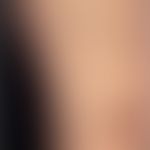 Differenzialdiagnose:&nbsp;Kollagenose reaktive perforierende

Diagnose: Papulosis maligna atroph...