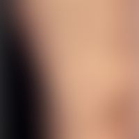 Differenzialdiagnose: Chronische Prurigo

Diagnose: Papulosis maligna atrophicans; fortgeschritte...