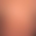 Dfferenzialdiagnose: Prurigo chronische

Diagnose: Kollagenose reaktive perforierende. Disseminie...