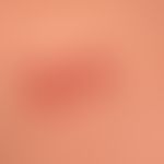 Differenzialdiagnose:&nbsp;Prurigo chronische

Diagnose: Reaktive perforierende Kollagenose (Deta...