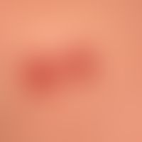 Differenzialdiagnose:&nbsp;Prurigo chronische

Diagnose: Reaktive perforierende Kollagenose (Deta...