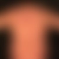 Differenzialdiagnose:&nbsp;Kollagenose reaktive perforierende

Diagnose: Chronische&nbsp;Prurigo
