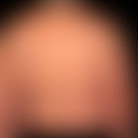 Erythema multiforme:&nbsp; akutes, wenige&nbsp;Tage&nbsp;bestehendes,&nbsp; symmetrisches&nbsp;Ex...
