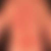 Erythema multiforme: 35-jährige Patientin mit Z.n. Herpes-simplex-Viren-Infektion vor 4 Wochen. M...