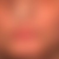 Erythema multiforme: 75-jährige Patientin mit generalisiertem EM. Dargestellt der Befall der Unte...