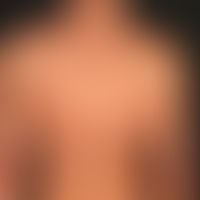 Atopische Dermatitis: schwere&nbsp;atopische Dermaitis mit großfächigen mäßig schuppigen Plaques....