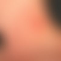 Atopische Dermatitis: schwere&nbsp;atopische Dermaitis mit großfächigen mäßig schuppigen Plaques....