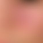 Lupus erythematodes chronicus discoides:&nbsp; Befund nach 3 Jahren
