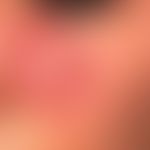 Lupus erythematodes chronicus discoides: umschriebener Herd über einen Zeitraum von 6 Jahren. Bef...