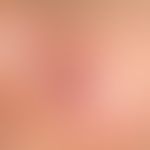 Lupus erythematodes chronicus discoides: umschriebener Herd über einen Zeitraum von 6 Jahren. Aus...