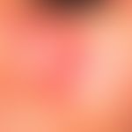 Lupus erythematodes chronicus discoides: umschriebener Herd über einen Zeitraum von 6 Jahren. Bef...