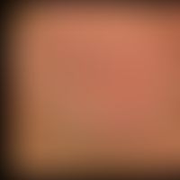 Keratosis pilaris (follicularis):&nbsp;follikelgebundene, spitzkegelige Hornpfröpfe der Wangenreg...