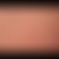 Keratosis Pilaris (follicularis):&nbsp;follikelgebundene Hornpapeln&nbsp;an Wangen, Augenbrauen u...