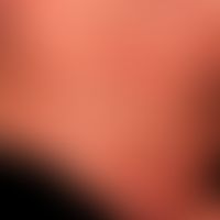 Diffuse kutane Mastozytose, mit gleichförmiger&nbsp;wachsartiger&nbsp;Hautbeschaffenheit. &nbsp;P...