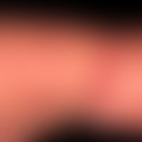 Diffuse kutane Mastozytose, mit gleichförmiger&nbsp;wachsartiger&nbsp;Hautbeschaffenheit. &nbsp;P...