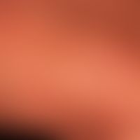 Diffuse kutane Mastozytose, mit gleichförmiger&nbsp;wachsartiger&nbsp;Hautbeschaffenhei.&nbsp;&nb...