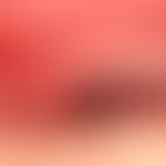 Schleimhautpemphigoid: frische Blase an der Oberlippe.&nbsp;

