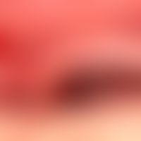 Schleimhautpemphigoid: frische Blase an der Oberlippe.&nbsp;

