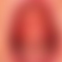 Differenziadliagnose: Aphthen

Diagnose: Schleimhautpemphigoid.
