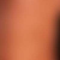 Differenzialdiagnose: Vitiligo

Diagnose.&nbsp;Albright-Syndrom; Nebeneinander von De- und Hyperp...