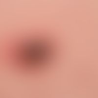 Keratose seborrhoische (papillomatöser Typ): braunes Knötchen mit psoriatischem Halo (Meyerson-Ph...