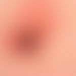 Keratose seborrhoische (papillomatöser Typ): braunes Knötchen mit breitem psoriatischem Halo (Mey...