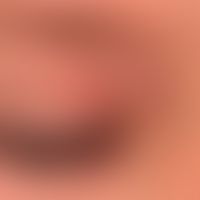 Differenzialdiagnose: Liddermatitis

Diagnose: Psoriasis (guttata-Typ); lieare Plaque, hier bei P...