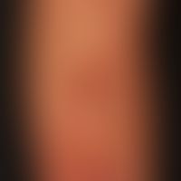 Lichen amyloidosus:&nbsp;&nbsp;flächige, unregelmäßig berandete, juckende braune&nbsp;Plaques.
