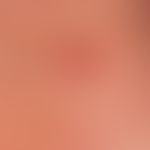 Keratosis actinica:&nbsp;flach erhabene leicht hyperkeratotische, rote Papel.

&nbsp;

