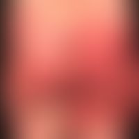 Differenzialdiagnose:&nbsp; Urtikaria

Diagnose:&nbsp;Symmetrical drug related intertriginous and...